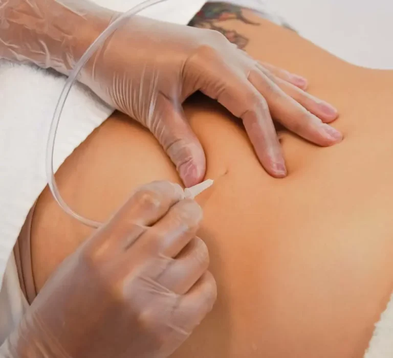 Tratamiento de carboxiterapia corporal aplicado por especialista estético