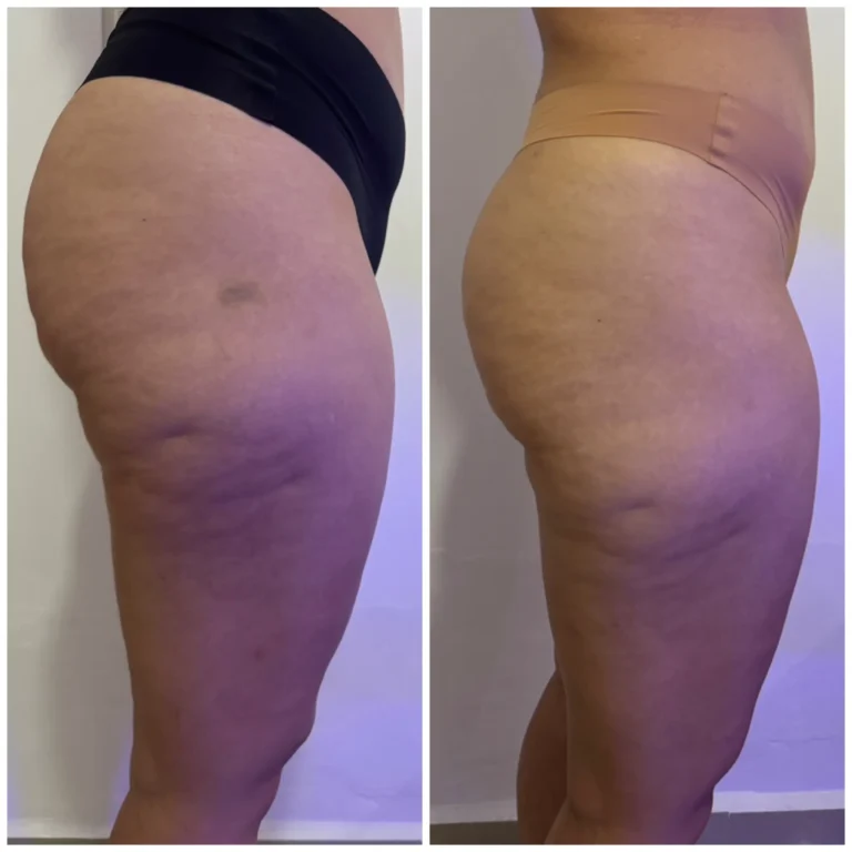 Mujer con reducción de grasa acumulada en glúteos mediante tratamiento de carboxiterapia